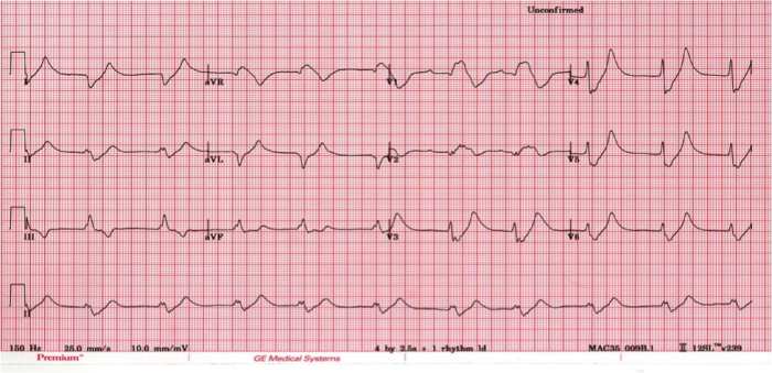 Brugada ecg syndrome type litfl sign criteria diagnosis treatment stratification clinical library definitive questionable significance isolation icd controversial further risk