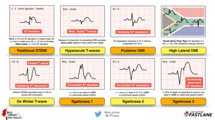 Torsades pointes tdp polymorphic vt litfl ecg strip ventricular tachycardia lifeinthefastlane lane fast life point pvt qrs