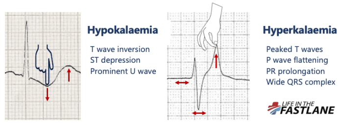 Ekg life in the fast lane