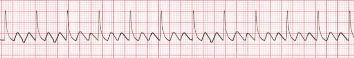 Ecg brugada syndrome life lane fast choose board emergency slideshare paramedic