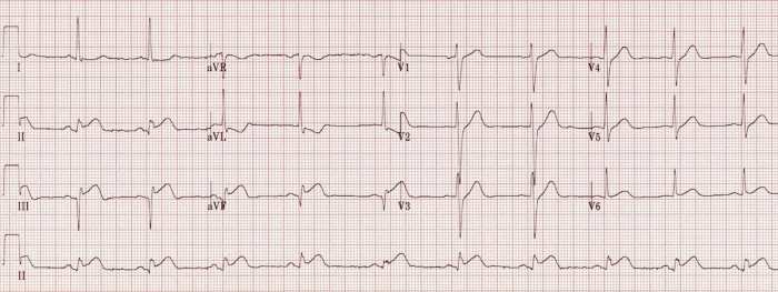 Sinus rhythm ekg ecg litfl nightmares nsr stemi tidak koleksi unduh admission foamed stitcher