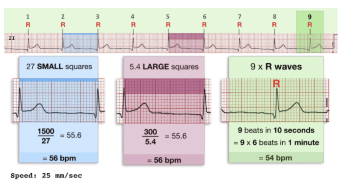 Ekg life in the fast lane